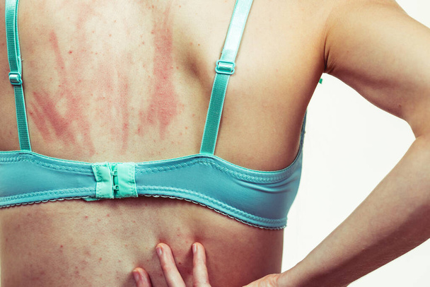 Woman with allergy rash scratching her itchy back. Young female with acne, red spots. Health care, skin diseases. - 写真・画像
