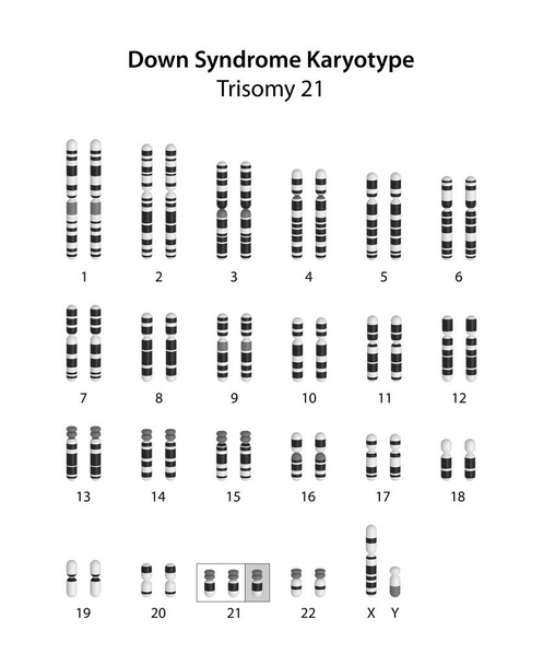 Síndrome de Down (trissomia 21) cariótipo humano - Foto, Imagem