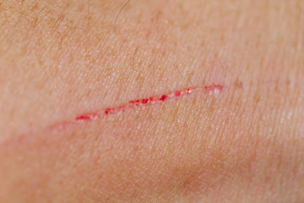 Heridas de arañazos por uñas de gato - Foto, imagen