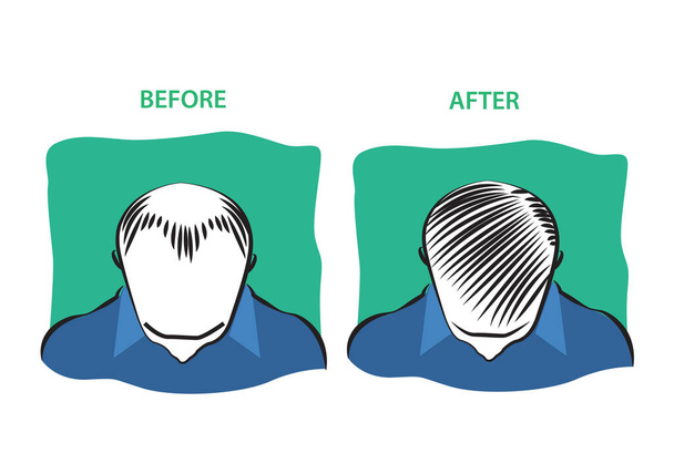 Лікування випадання волосся до і після діаграми. Редагувати мистецтво кліпу
 - Вектор, зображення