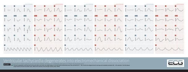 Paroksismal ventriküler taşikardi başlangıcından itibaren hastanın QRS dalgası kademeli olarak uzar ve kalp atışları VT 'den elektromekanik parçalanmaya kadar kademeli olarak yavaşlar.. - Fotoğraf, Görsel
