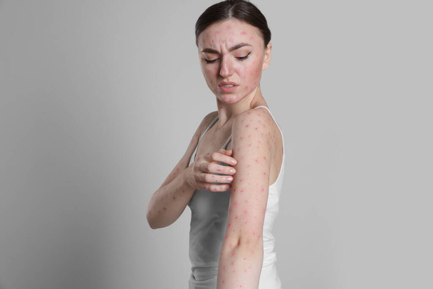 Woman with rash suffering from monkeypox virus on light grey background - Photo, Image