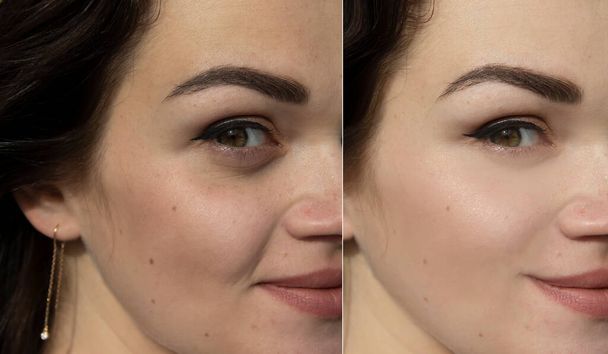 治療前と治療後の女性の顔のしわ - 写真・画像