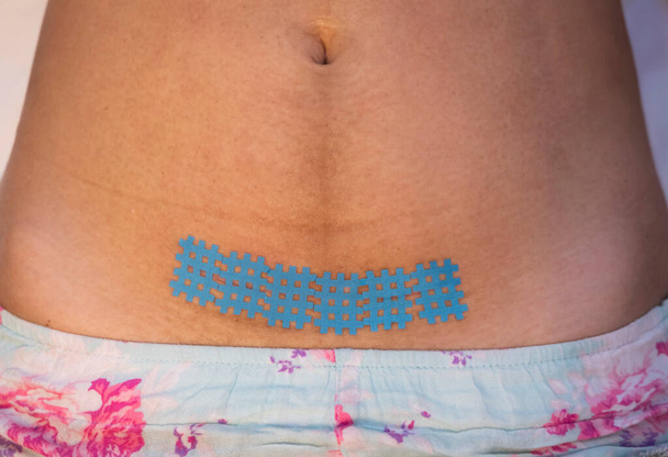 Ein Kinesiologie-Band auf eine Narbe nach einem Kaiserschnitt kleben. Erholung nach der Geburt. - Foto, Bild