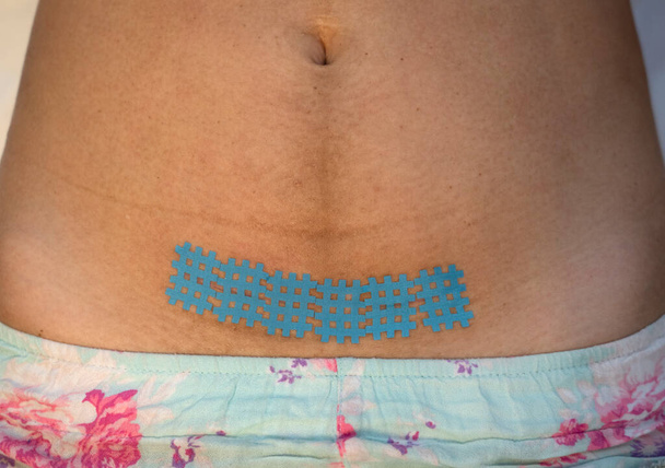 Ein Kinesiologie-Band auf eine Narbe nach einem Kaiserschnitt kleben. Erholung nach der Geburt. - Foto, Bild