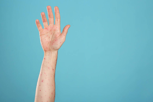 Man with rash suffering from monkeypox virus on light blue background, closeup. Space for text - 写真・画像