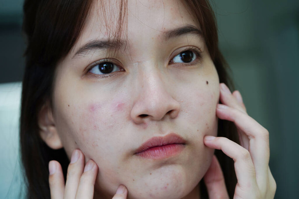 Acne puistje en litteken op het gezicht van de huid, aandoeningen van talgklieren, tiener meisje huidverzorging schoonheidsprobleem.      - Foto, afbeelding