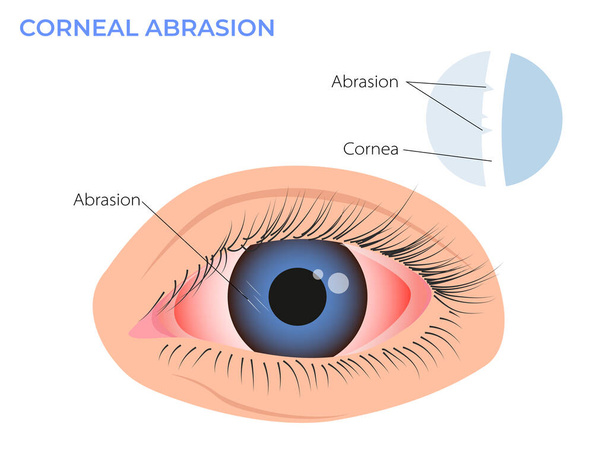 Illustrazione dell'abrasione corneale. Sintomo di arrossamento oculare. occhio di surfista rosso rosa - Vettoriali, immagini
