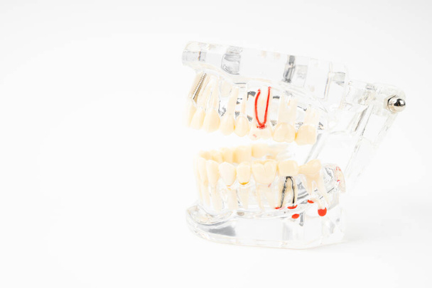 Dentures model, abutment and human teeth and dentures on white background. - 写真・画像