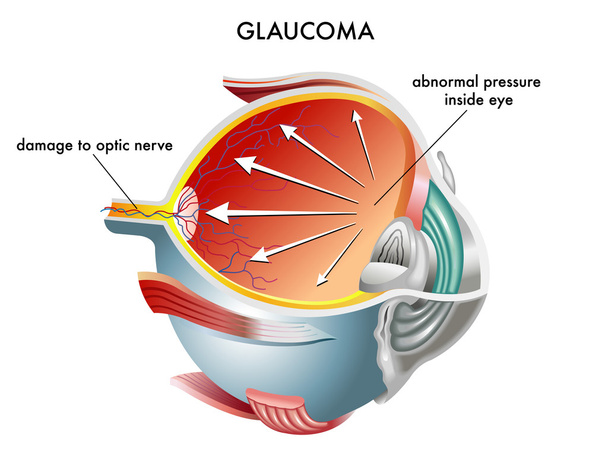 Glaucoma anatomía ocular
 - Vector, Imagen