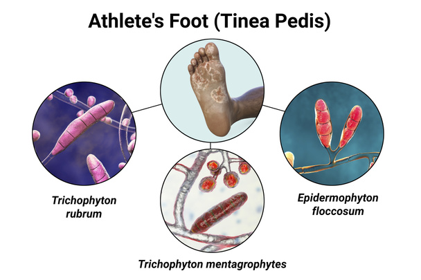 Der Fuß einer dunkelhäutigen Person mit Mykose und Nahaufnahme der Pilze Epidermophyton floccosum, Trichophyton mentagrophytes und T. rubrum, die den Fuß des Athleten verursachen, 3D-Illustration - Foto, Bild