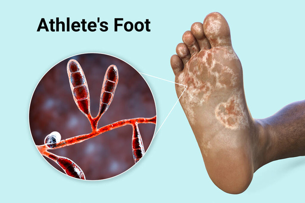 Noha osoby s tmavou pletí s mykózou, a detailní pohled na houby Epidermophyton flocosum, které způsobují nohu sportovce, 3D ilustrace - Fotografie, Obrázek