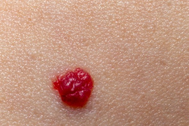 Червоний моль на шкірі екстремальний вид крупним планом, макро
 - Фото, зображення