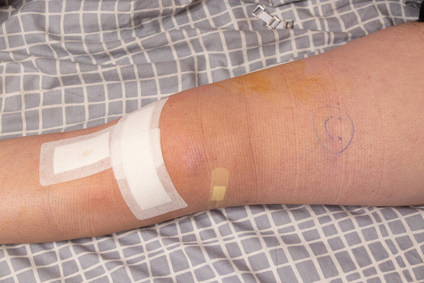 Человеческая нога с клейкой лентой после операции на колене на кровати, ноге - Фото, изображение