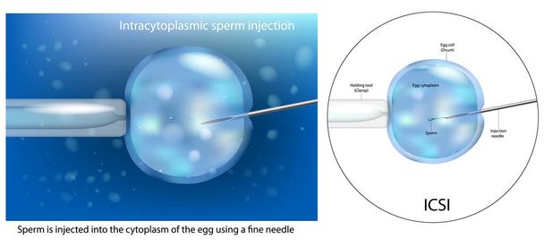 La procédure d'injection intracytoplasmique de sperme ICSI. Insémination artificielle fécondation in vitro. macro FIV. Diagramme scientifique - Vecteur, image