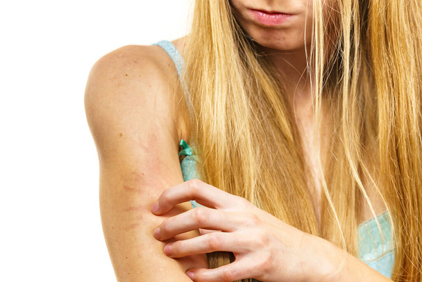 Itchy skin, dermatitis, food allergies. Woman having itching, scratching her arm with allergy rash. - Foto, Bild