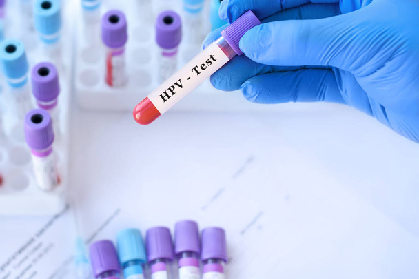 Γιατρός που κρατά δοκιμαστικό σωλήνα δείγματος αίματος με HPV δοκιμή στο παρασκήνιο των ιατρικών δοκιμαστικών σωλήνων με αναλύσεις. - Φωτογραφία, εικόνα