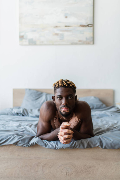 Shirtless african american man with vitiligo looking at camera while lying on bed at home  - Foto, Bild