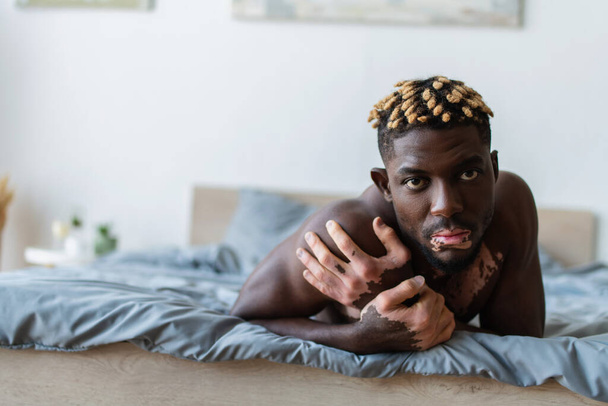 Muskulöser afrikanischer Mann mit Vitiligo, der auf dem Bett liegend in die Kamera schaut  - Foto, Bild