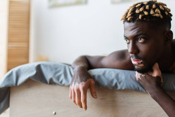 Shirtless african american man with vitiligo looking away while lying on bed  - 写真・画像