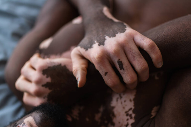 Oříznutý pohled na africký Američan muž s vitiligo dotýkání ruku při ležení na posteli doma  - Fotografie, Obrázek