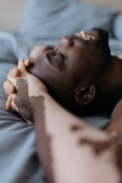 Side view of african american man with vitiligo resting on bed at home  - Photo, Image