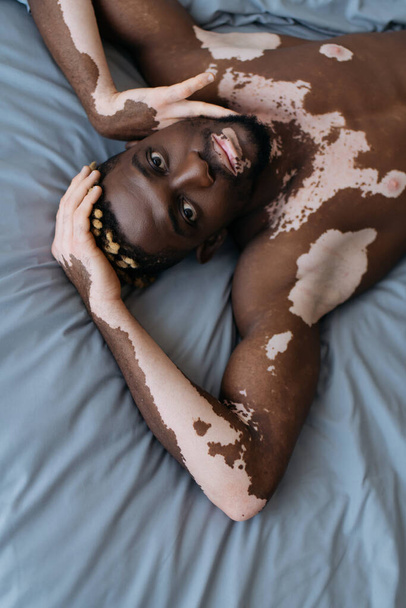Top view of muscular african american man with vitiligo looking at camera while lying on bed  - Foto, imagen