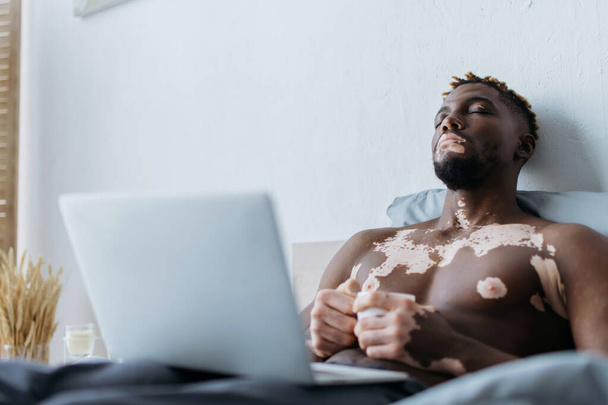 Cansado afroamericano hombre con vitiligo celebración de café cerca de la computadora portátil en la cama  - Foto, Imagen