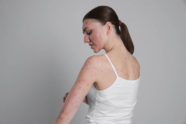 Woman with rash suffering from monkeypox virus on light grey background - Photo, Image