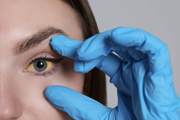 Woman checking her health condition on light grey background, closeup. Yellow eyes as symptom of hepatitis - Foto, Imagem