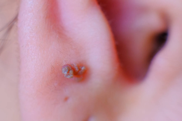 κοντινή φωτογραφία δερματικών κονδυλωμάτων στο λοβό του αυτιού ενός κοριτσιού - Φωτογραφία, εικόνα