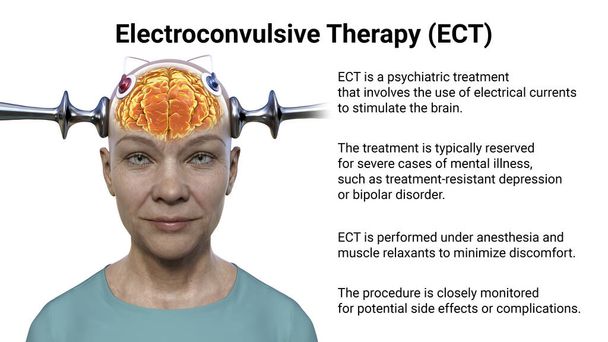 Elektroconvulsieve therapie, ECT, een behandeling voor ernstige geestesziekten waarbij elektrische stromen worden gebruikt om de hersenen te stimuleren, 3D-illustratie - Foto, afbeelding