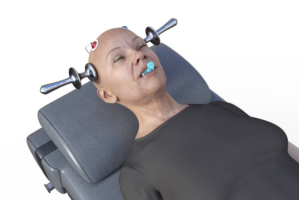 Terapia electroconvulsiva, ECT, un tratamiento utilizado para enfermedades mentales graves que implican el uso de corrientes eléctricas para estimular el cerebro, ilustración 3D - Foto, imagen