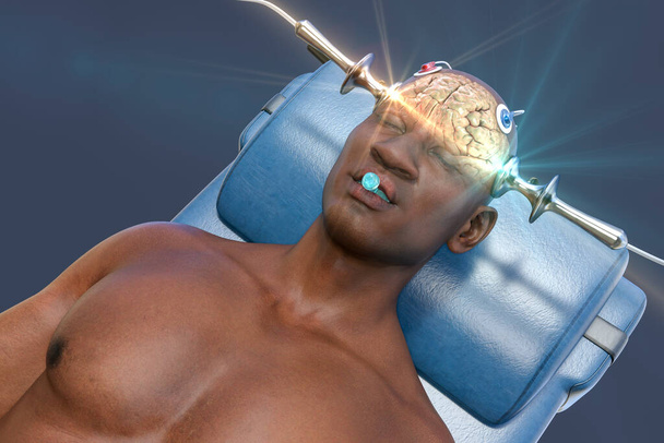 Terapia elettroconvulsiva, ECT, un trattamento usato per gravi malattie mentali che coinvolgono l'uso di correnti elettriche per stimolare il cervello, illustrazione 3D - Foto, immagini