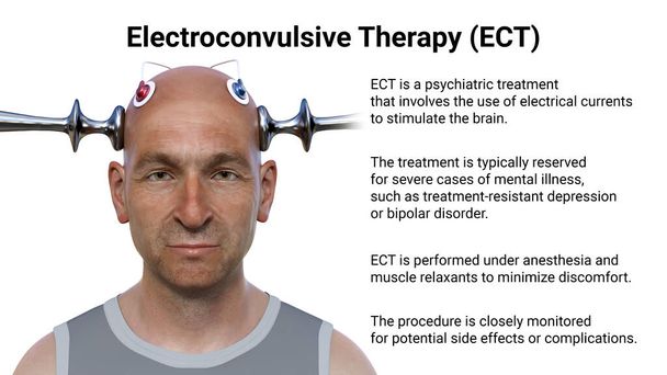 Terapia eletroconvulsiva, ECT, um tratamento usado para doenças mentais graves que envolvem o uso de correntes elétricas para estimular o cérebro, ilustração 3D - Foto, Imagem