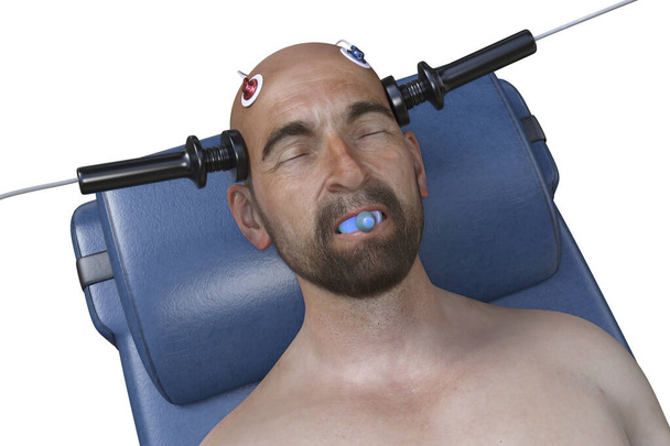 電気痙攣療法, ECT,脳を刺激する電流の使用を含む重度の精神疾患に使用される治療, 3Dイラスト - 写真・画像