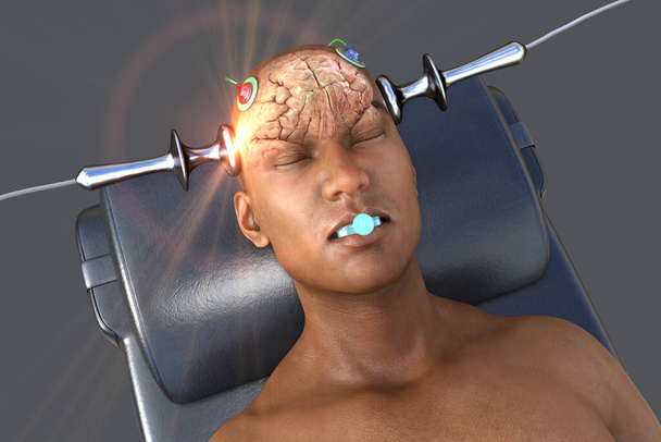 Terapia eletroconvulsiva, ECT, um tratamento usado para doenças mentais graves que envolvem o uso de correntes elétricas para estimular o cérebro, ilustração 3D - Foto, Imagem