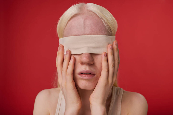 Muotokuva nuori albiino tyttö side hänen silmänsä eristetty punaisella pohjalla - Valokuva, kuva