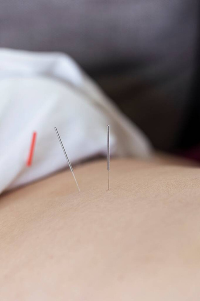 Um retrato de perto de uma agulha de acupuntura colando em uma pessoa pele e corpo para curar ou relaxar. Um acupunturista fornece este medicamento alternativo para alívio do estresse ou para curar doenças ou dores. - Foto, Imagem