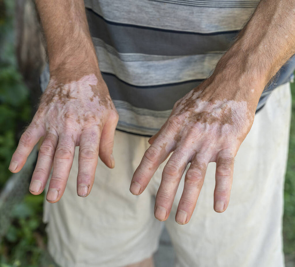 Симптоми вітіліго на шкірі людини
 - Фото, зображення