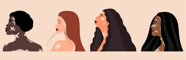 Set of young women with vitiligo on beige background - Vector, Image