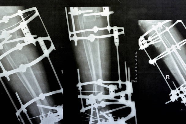 Distal comminuted fracture fibula managed by plate and screws, distal tibia managed by external ring fixator ILIZAROV frame with sclertoic bone resection and proximal corticotomy and segment transfer - Photo, Image