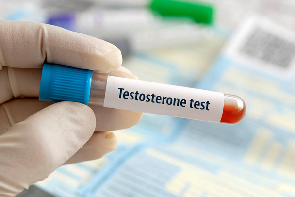 Wynik testu hormonalnego testosteronu z próbką krwi w probówce na ręce lekarza w laboratorium medycznym na niebieskim tle laboratoryjnym. - Zdjęcie, obraz