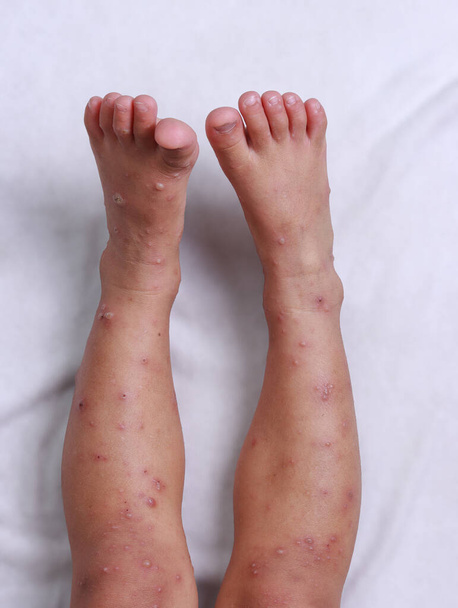 hfmd-virusihottuma lapsen molemmilla jaloilla kipu lääketieteellinen hoito epidemia sadekausi valkoinen tausta eristetty vihurirokko kutiava tuhkarokko - Valokuva, kuva