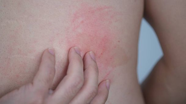 Közelkép a bőr textúra szenved súlyos csalánkiütés vagy csalánkiütés vagy kaligata a háton - Fotó, kép