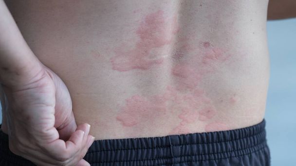 Close up image of skin texture suffering severe urticaria or hives or kaligata on back - Photo, Image