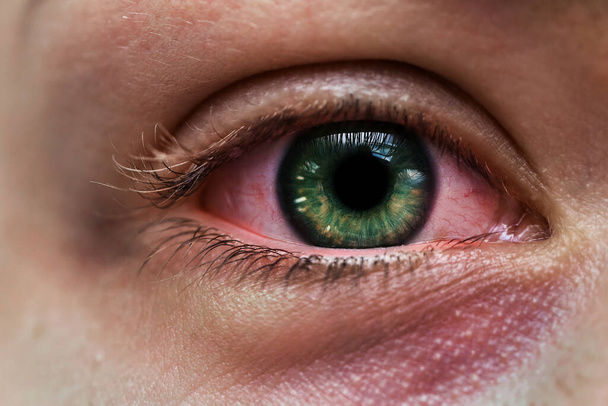 Closeup of infected female eye with a green iris and subconjunctival hemorrhage - Foto, Imagem
