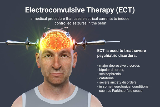 Electroconvulsive therapy, ECT, a treatment used for severe mental illnesses involving the use of electrical currents to stimulate the brain, 3D illustration - Photo, Image