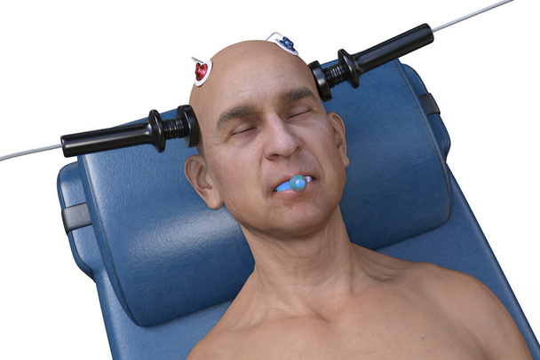 Terapia elettroconvulsiva, ECT, un trattamento usato per gravi malattie mentali che coinvolgono l'uso di correnti elettriche per stimolare il cervello, illustrazione 3D - Foto, immagini
