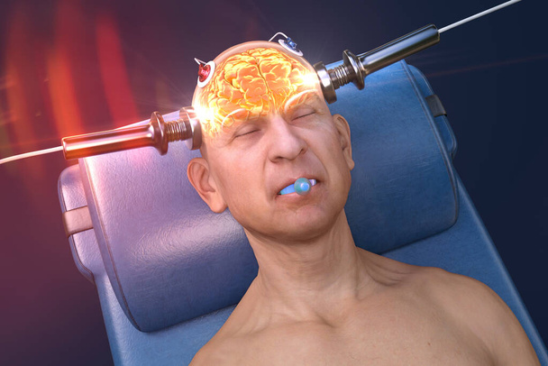 Електроконвеєрна терапія (ЕКТ) - лікування, що застосовується для тяжких психічних захворювань, пов "язаних з використанням електричних струмів для стимулювання мозку, 3D-ілюстрація. - Фото, зображення